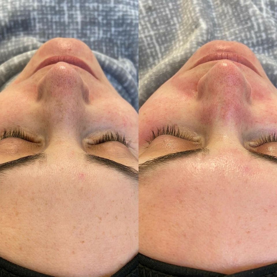 Microneedling für nur 99€! Duisburg in Duisburg