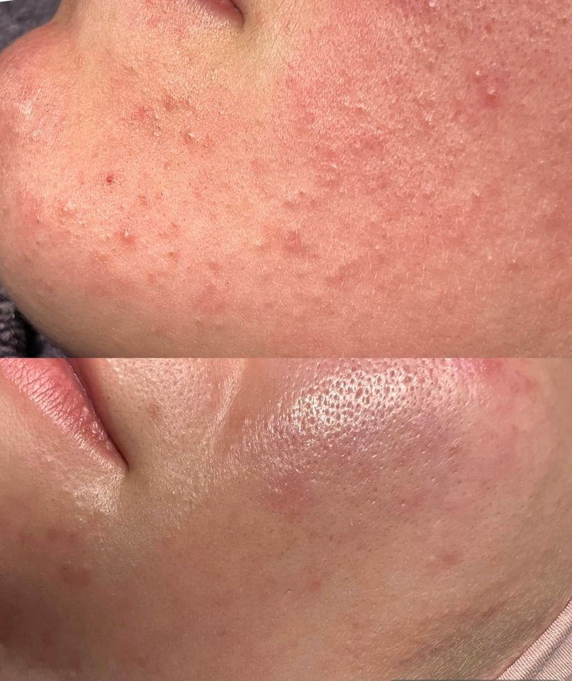 Diamant Microdermabrasion für nur 79€ in Duisburg