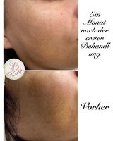 Microneedling&Hydrabeauty&Lichttherapie anti aging, glowing Essen - Essen-Stadtmitte Vorschau