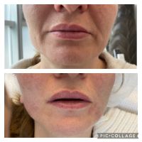 PDO-Fadenlifting * Softlifting * Facelift * Browlift Hamburg-Mitte - Hamburg Neustadt Vorschau