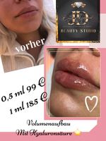 Lippenvolumen mit Hyaluron Dortmund - Aplerbeck Vorschau