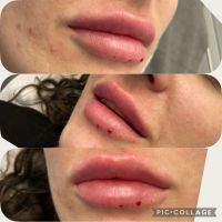 Lippenunterspritzung * Faltenunterspritzung * Contouring Hamburg-Mitte - Hamburg Neustadt Vorschau