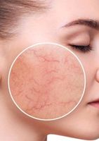 Rosacea Säurebehandlung Berlin - Treptow Vorschau