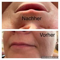 Collagen Fadenlifting (ohne Nadel) Essen-Borbeck - Essen-Vogelheim Vorschau