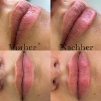 Lippen aufspritzen mit Hyaluron 0.5 ml Bielefeld - Brackwede Vorschau