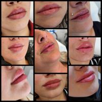 Lippenunterspritzung Russian Lips Lippen Nordrhein-Westfalen - Hemer Vorschau