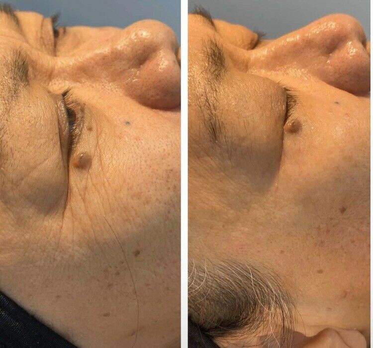 Microneedling für nur 99€! Duisburg in Duisburg