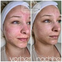 Microneedling/ BB Glow Rheinland-Pfalz - Landau in der Pfalz Vorschau