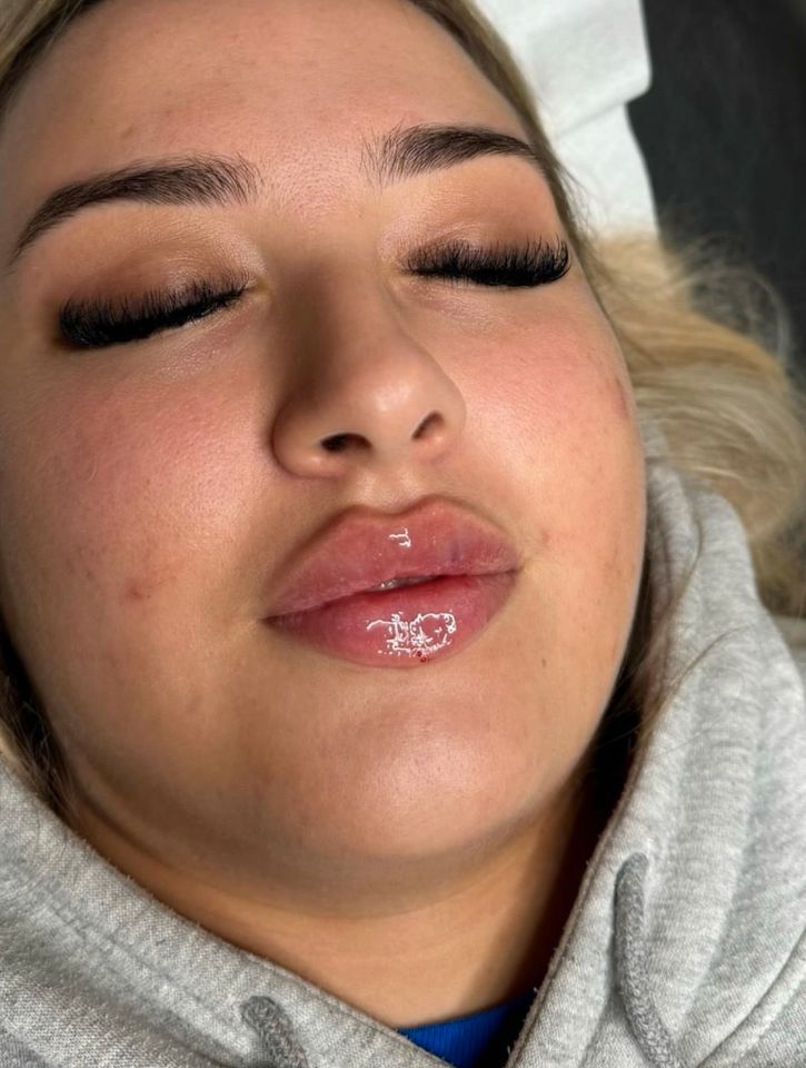 Russianlips Lippen Hyaluron Botox in Hamburg