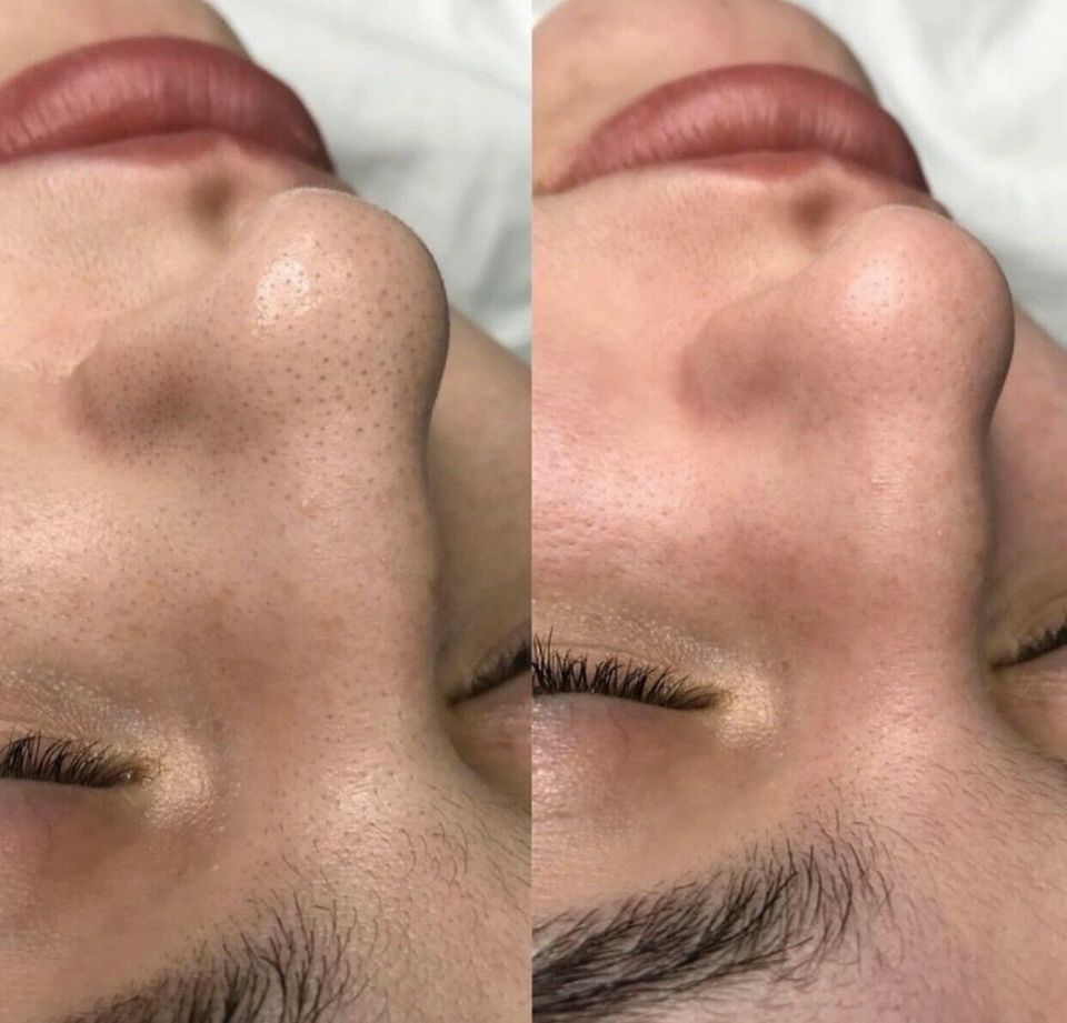 Microneedling in Nürnberg (Mittelfr)