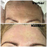 Microneedling, BB Glow, Gesichtsbehandlung Baden-Württemberg - Göppingen Vorschau