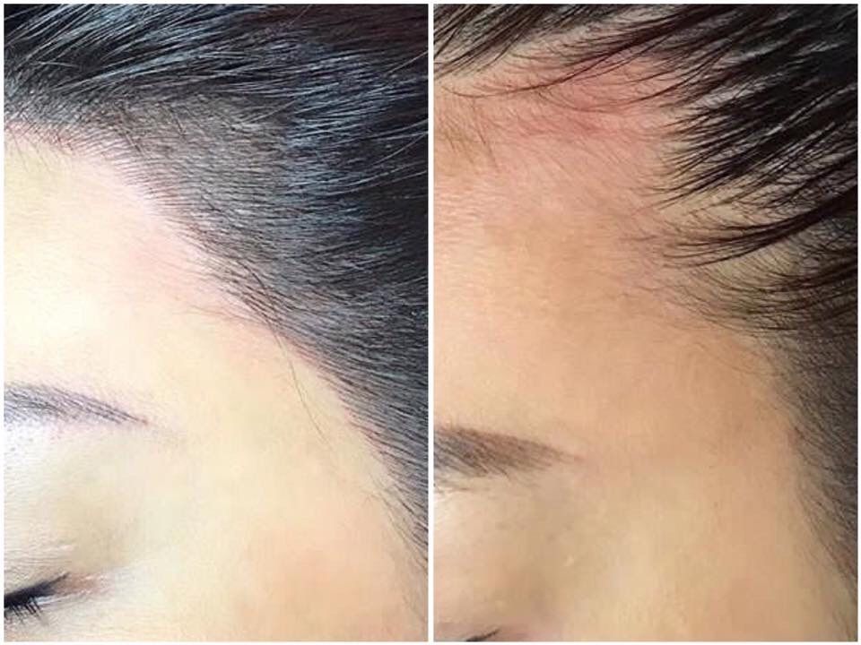 Hairline Microblading, optische Haarverdichtung in Bremen