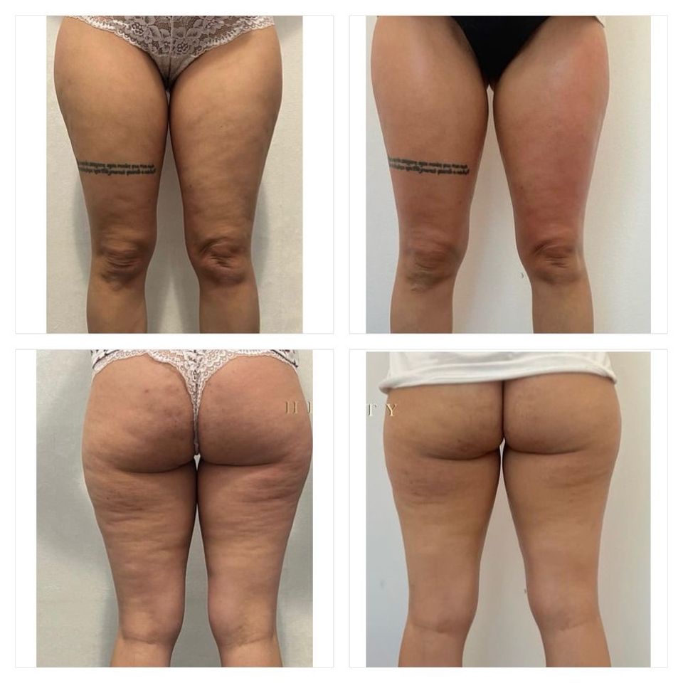 G5 Massage Bodyformer Abnehmen Fettreduktion Cellulite Behandlung in Witten