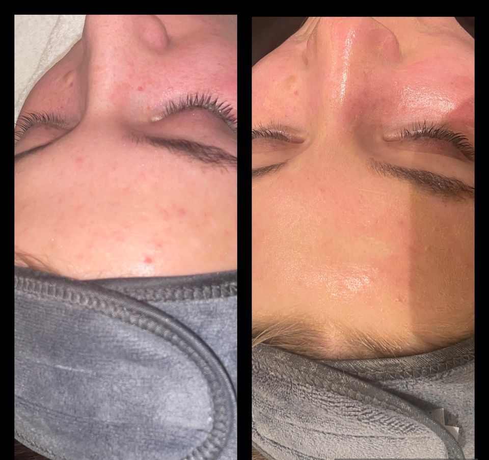 Microneedling , BB-Glow, Gesichtsbehandlung, Beauty in Melbeck in Lüneburg