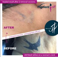 Entfernung von Permanent Make-up,Microblading, Tattoos, Lidstrich Niedersachsen - Achim Vorschau