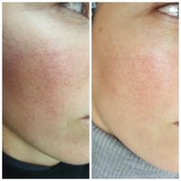 Couperose, Rosacea Kosmetik Gesichtsbehandlung ANGEBOT Hannover - Südstadt-Bult Vorschau