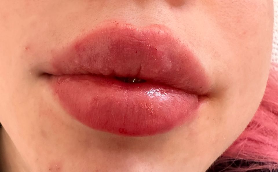 Russian Lips  Hyaluron , Lippen Unterspritzen in Köln