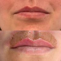 Liplift, Lippenvergrößerung mit PlasM Bremen - Blumenthal Vorschau