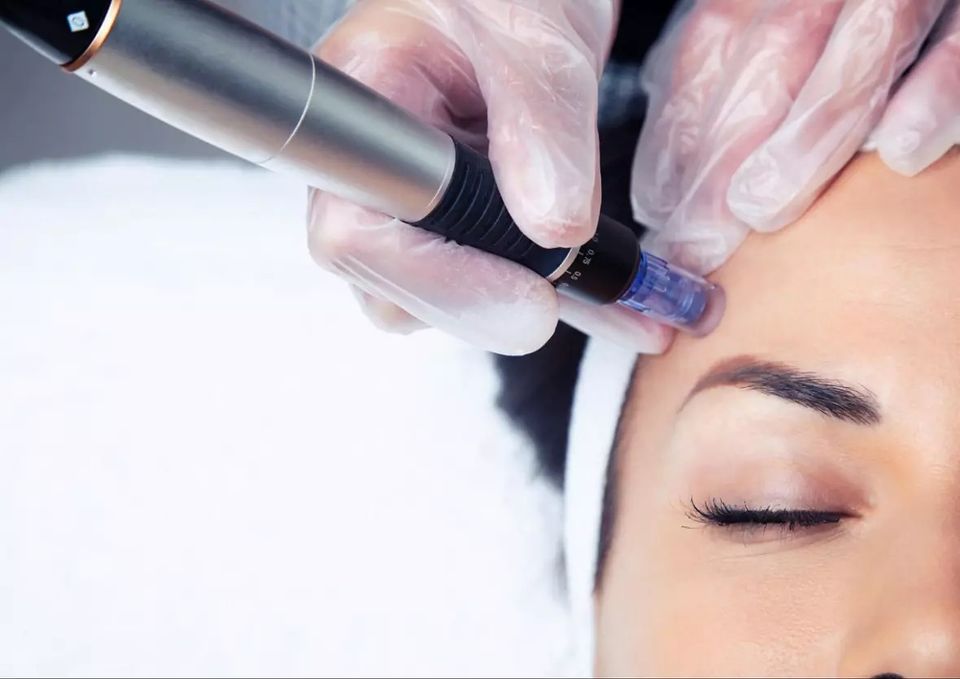 Microneedling Meso  mit Microdermabrasion und Heimpflege Produkte in Barsinghausen