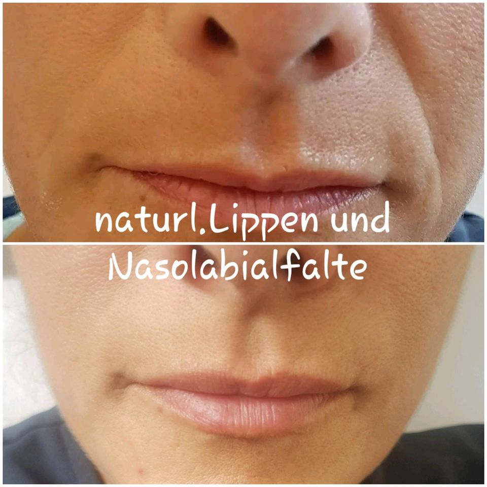 Russian Lips, Hyaluron, Filler, Lippenunterspritzung, Falten in Duisburg