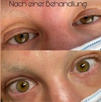 Augenlidstraffung/ Schlupf-/ Ober-/ Unterlidstraffung/ Augenringe Hannover - Linden-Limmer Vorschau
