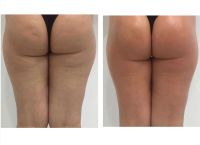 G5 Massage Bodyformer Abnehmen Fettreduktion Cellulite Behandlung Nordrhein-Westfalen - Witten Vorschau