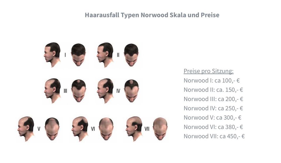 Haarpigmentierung SMP Haarpigmentation bei Haarausfall in Bersenbrück