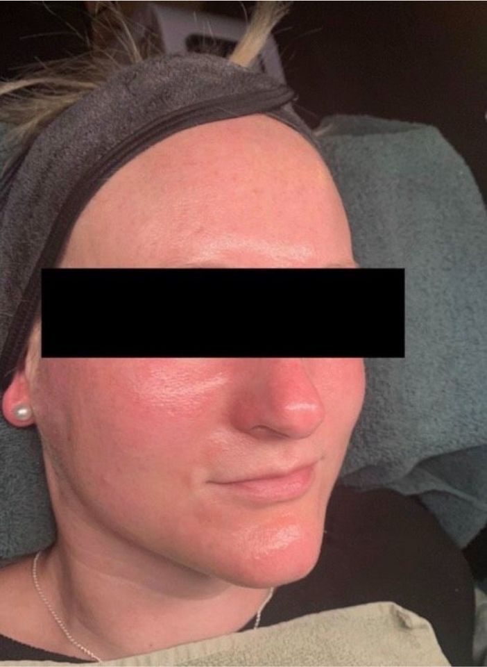 Microneedling Gesichtsbehandlung Hautbehandlung Kosmetik in Seevetal