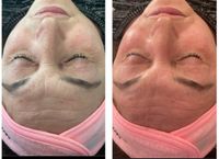 Microneedling Behandlung ink. intensive Hautreinigung Kreis Pinneberg - Kummerfeld Vorschau