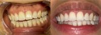 Kosmetısche Zahnaufhellung Classıc Hollywood Smile im Studio ❤️ Walle - Handelshäfen Vorschau