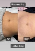 Microneedling/ BB Glow Behandlung Nordrhein-Westfalen - Moers Vorschau