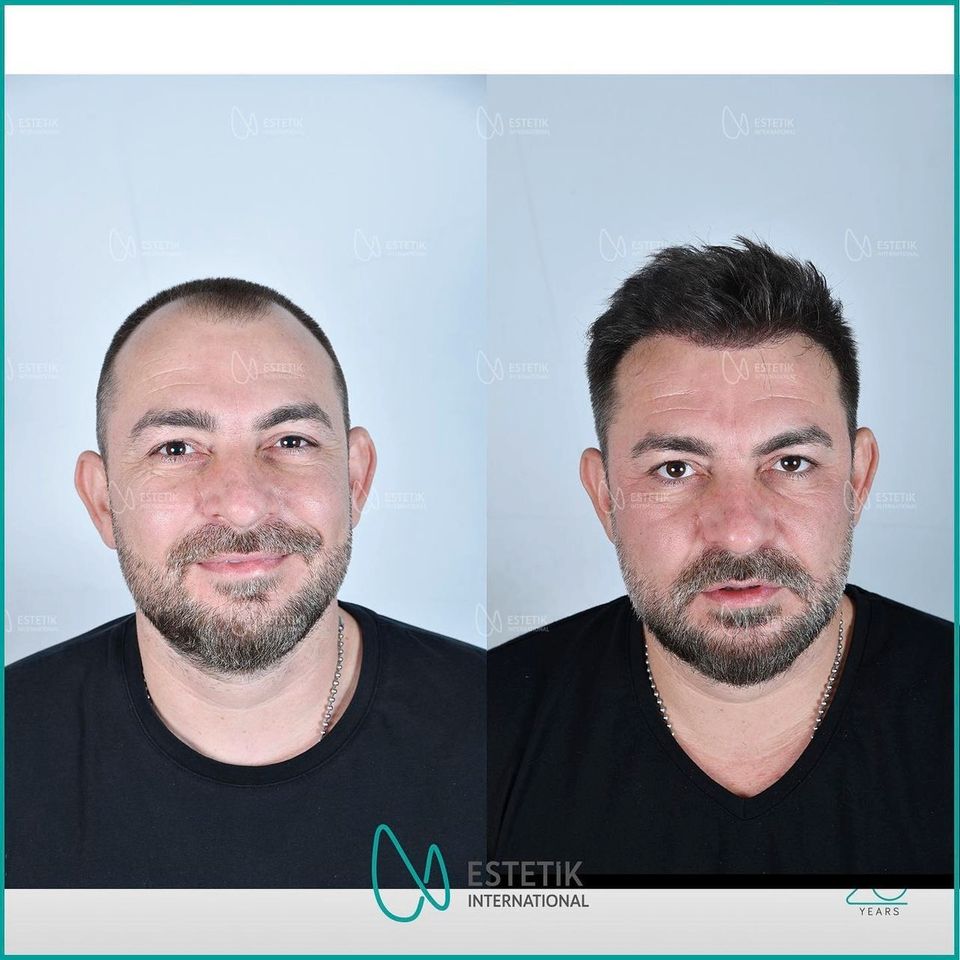 Haartransplantation in der Türkei für 1600€ inkl. Hotel+Transfer in Mühlacker
