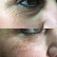 Microneedling + Plasma Pen Kombi Schulung mobil möglich Nordrhein-Westfalen - Herford Vorschau