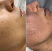 Microneedling Nürnberg (Mittelfr) - Gebersdorf Vorschau