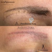 PhiRemoval Permanent make-up entfernung Duisburg - Duisburg-Mitte Vorschau