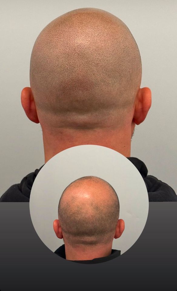 Haarpigmentierung Hair Tattoo in Rosenheim SMP Scalp Micro Pigmentation Haartätowierung Haar Pigmentierung Rosenheim in Rosenheim