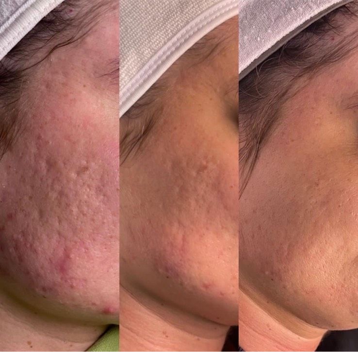 Microneedling in Gelsenkirchen