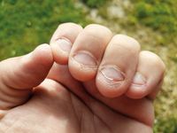 Hilfe bei Nägel kauen: Hypnose – auch online – gegen Nägel kauen Nordrhein-Westfalen - Solingen Vorschau