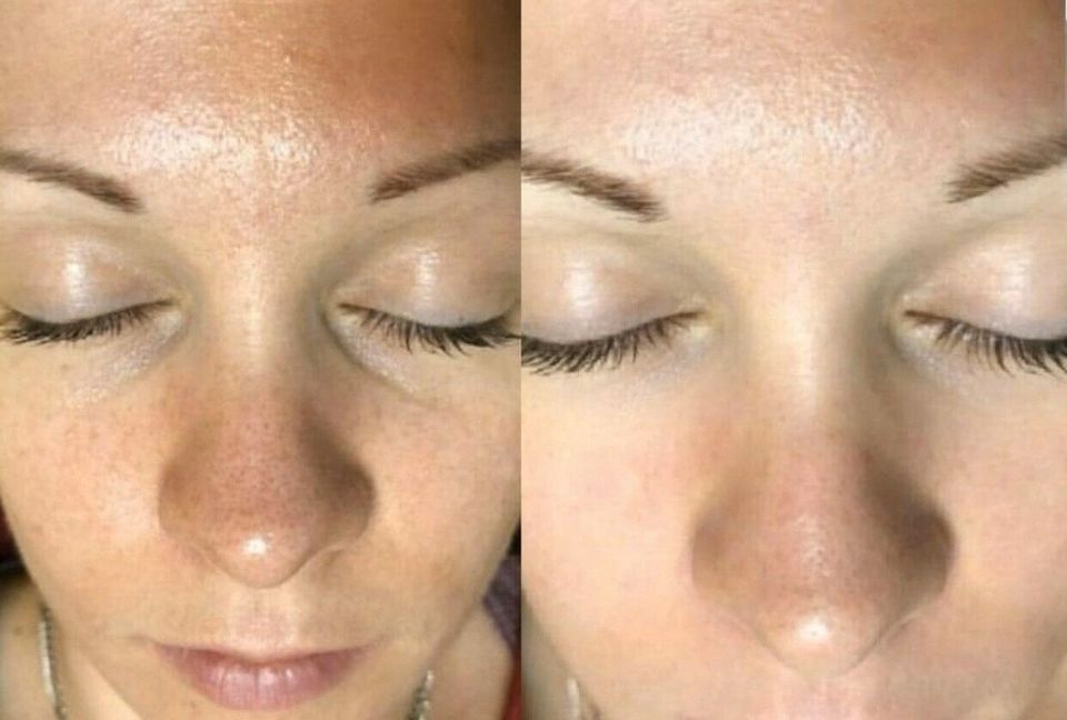 Microneedling in Nürnberg (Mittelfr)