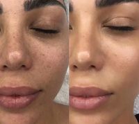 Bb Glow & Microneedling Duisburg - Fahrn Vorschau