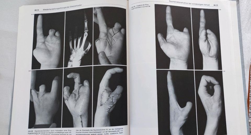 Handchirurgie in 2 Bänden, Nigst, Buck-Gramcko, Millesi in Bergisch Gladbach