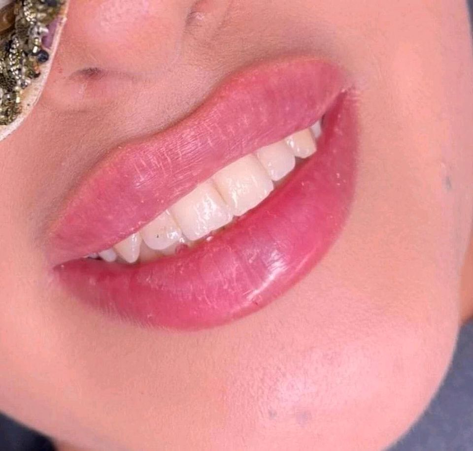 Russian Lips (Lippen unterspritzung) in Rosenheim