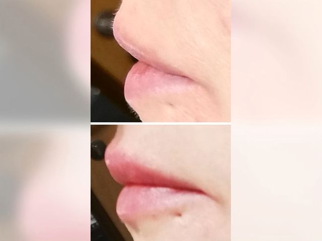 HYALURON - Aufpolsterung - 1 ml / Lippen - Nase - Falten in Paderborn