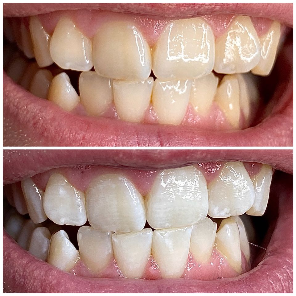 Biete Zahnkosmetisches Bleaching, Zahnschmuck u. Reinigung an in Rhauderfehn
