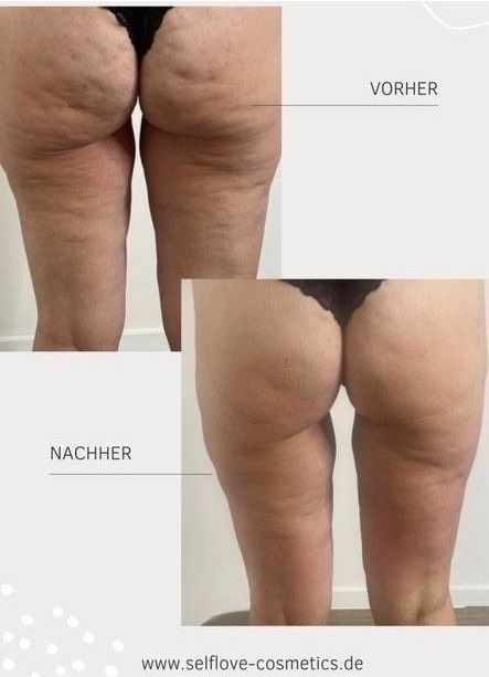 G5 Massage Bodyformer Abnehmen Fettreduktion Cellulite Behandlung in Witten