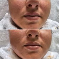 Microneedling-Bb-glow-Bb-Lips-Gesichtsbehandlung Essen - Essen-Stadtmitte Vorschau