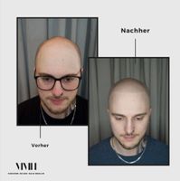 Haarpigmentierung in Berlin Modern Micro Hair Kostenlose Beratung Pankow - Prenzlauer Berg Vorschau