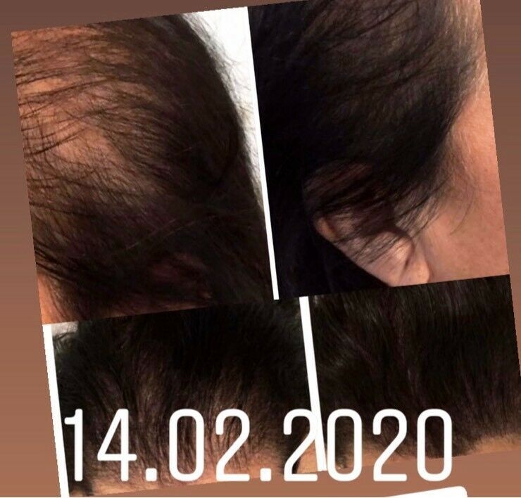 Kopfhautpigmentierung -Scalp -Haarneedling Schulung in Bad Vilbel