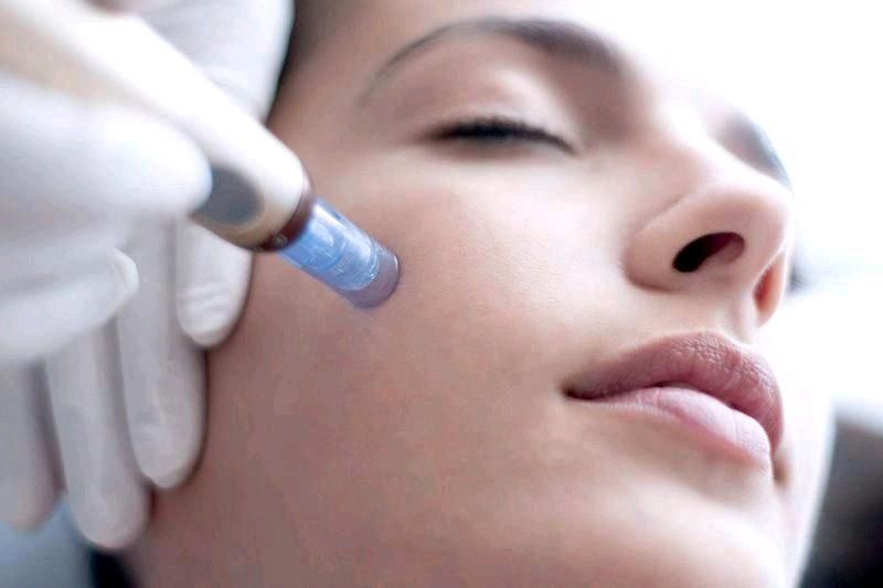 Microneedling in Paderborn