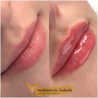 Russian Lips Unterspritzung / Schöne volle Lippen Niedersachsen - Ganderkesee Vorschau